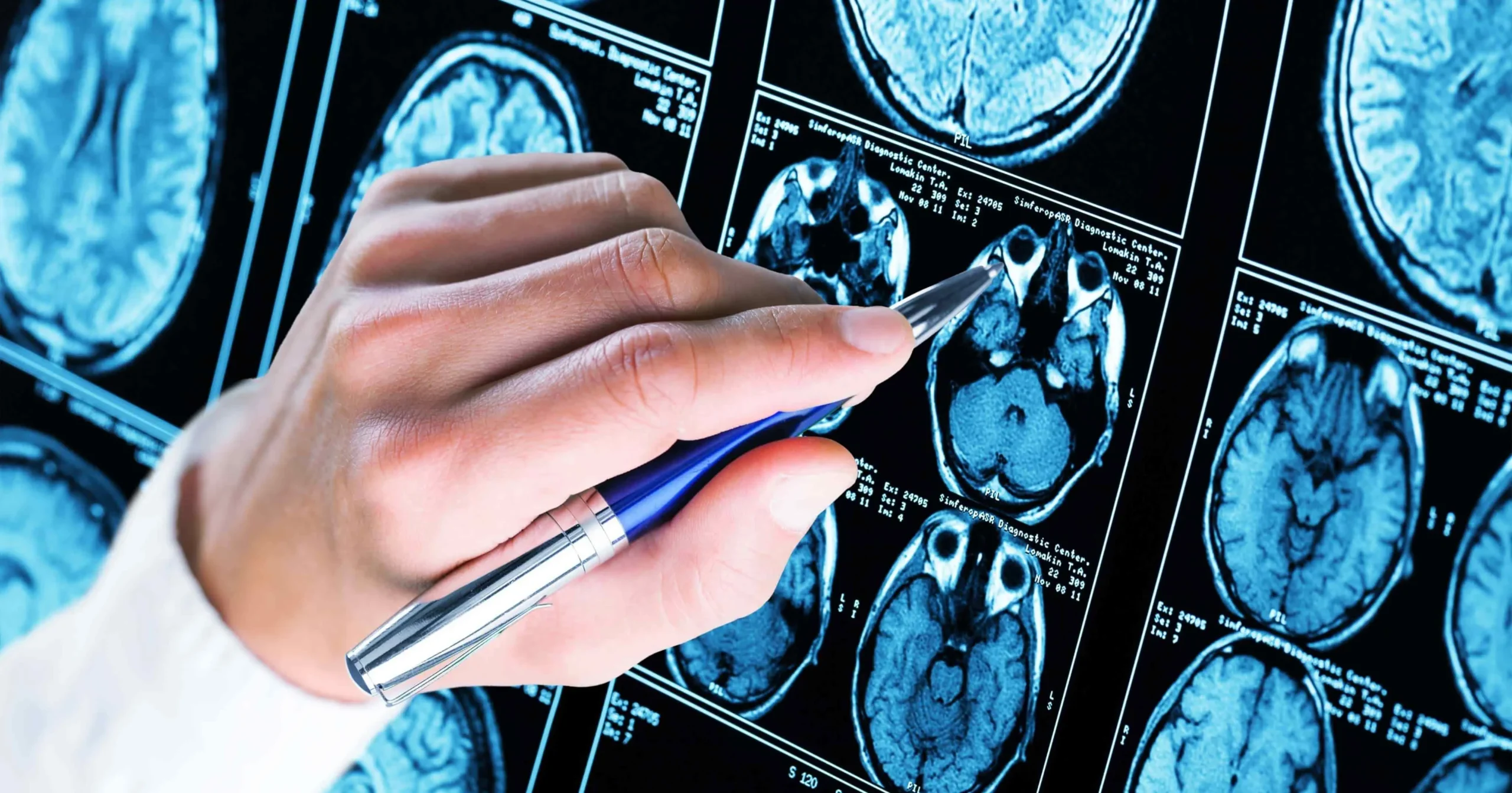 Medico neurologo che analizza una risonanza magnetica del cervello, immagine per l'articolo sulla correlazione tra dieta ed epilessia.