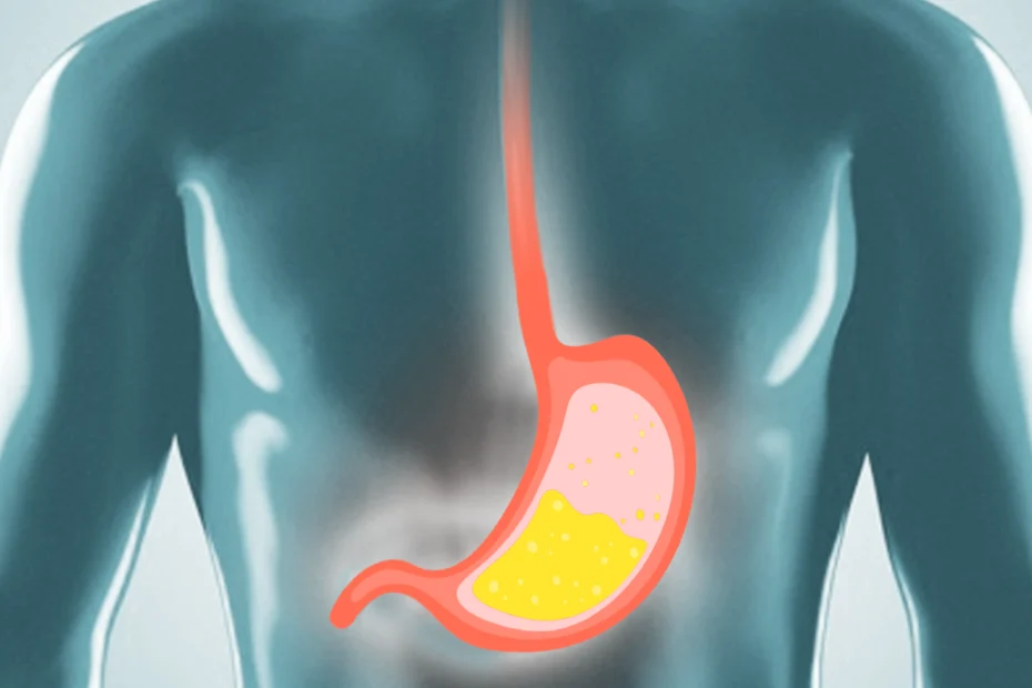 Rappresentazione grafica del reflusso gastroesofageo, con i succhi acidi che risalgono dallo stomaco all'interno dell'esofago.