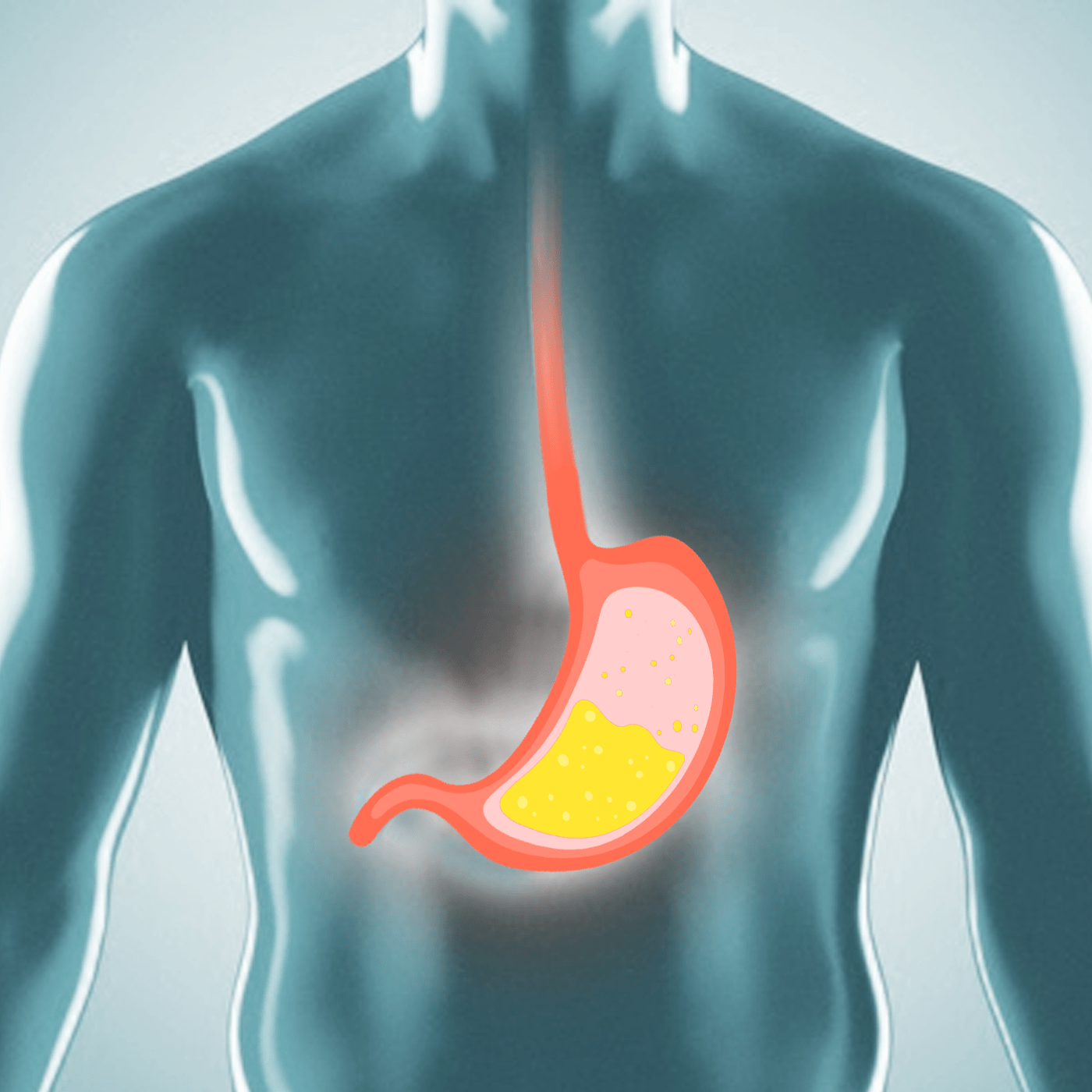 Rappresentazione grafica del reflusso gastroesofageo, con i succhi acidi che risalgono dallo stomaco all'interno dell'esofago.